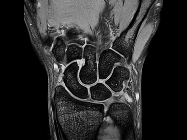 Coronal mFFE