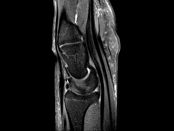 Sagittal PDw SPAIR