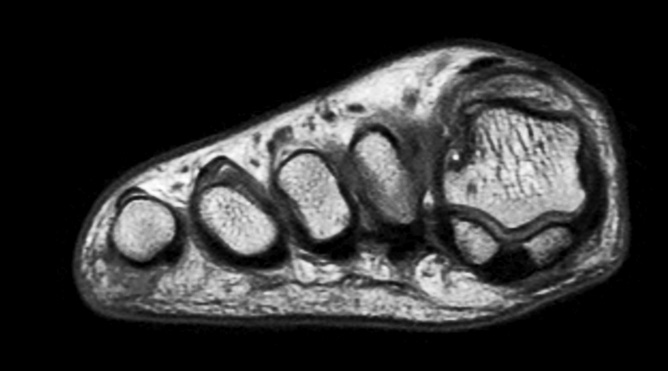 Axial PDw mDIXON TSE  (In Phase)