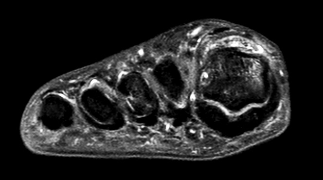 Axial PDw mDIXON TSE  (water only)