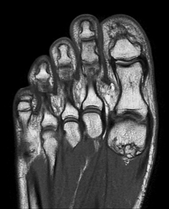 Coronal PDw mDIXON TSE (In Phase)
