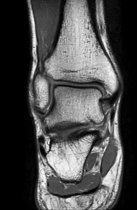 Coronal PDw mDIXON TSE (In Phase)