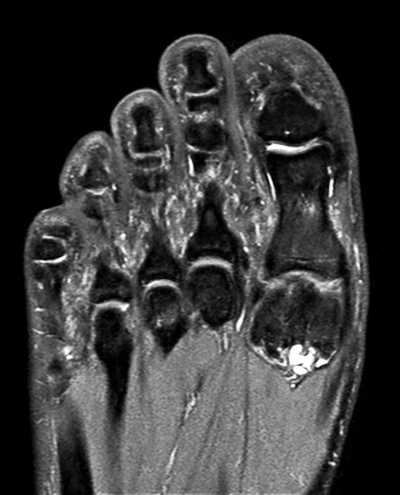 Coronal PDw mDIXON TSE  (water only)