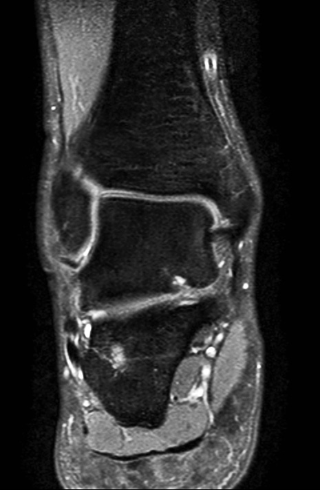 Coronal PDw mDIXON TSE  (water only)
