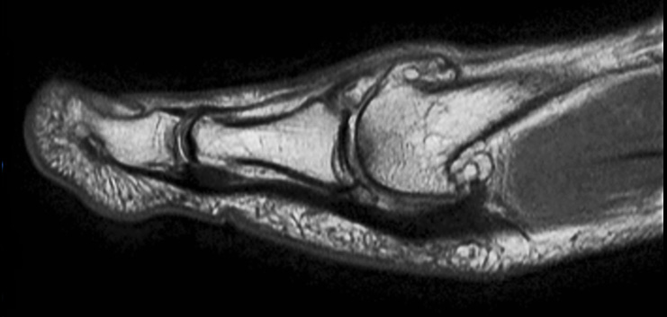 Sagittal PDw mDIXON TSE (In Phase)
