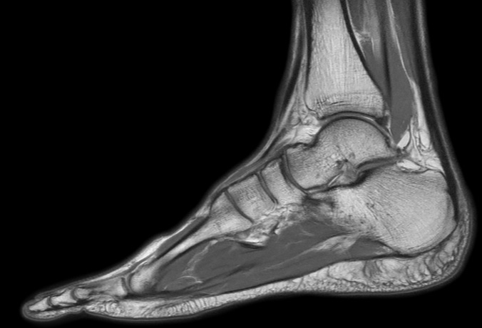 Sagittal PDw mDIXON TSE  (In Phase)