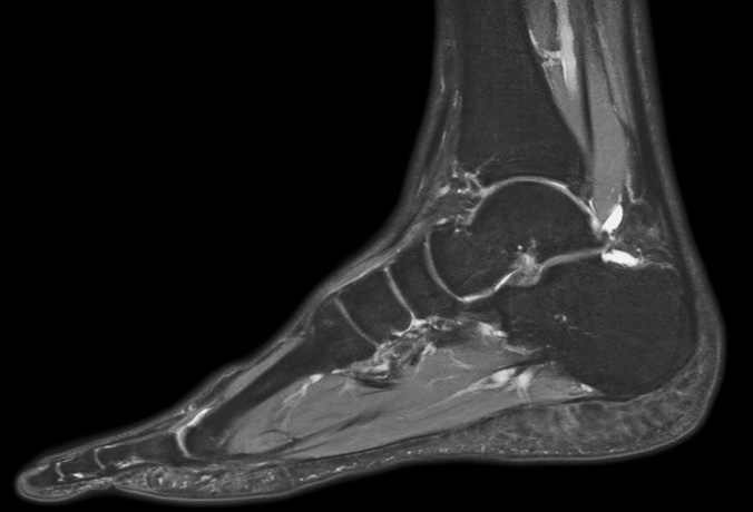 Sagittal PDw mDIXON TSE  (water only)