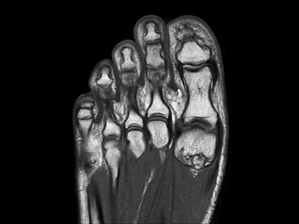 Coronal PDw mDIXON TSE (In Phase)