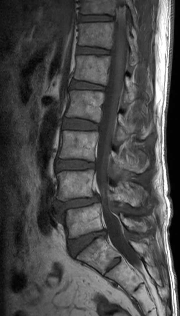 Sagittal T1w TSE