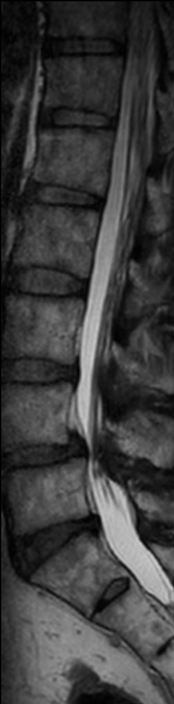 T2w 3D SpineVIEW (sagittal reformat)