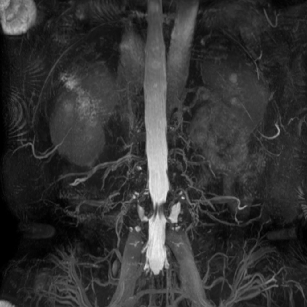 Coronal 3D bTFE (MIP)