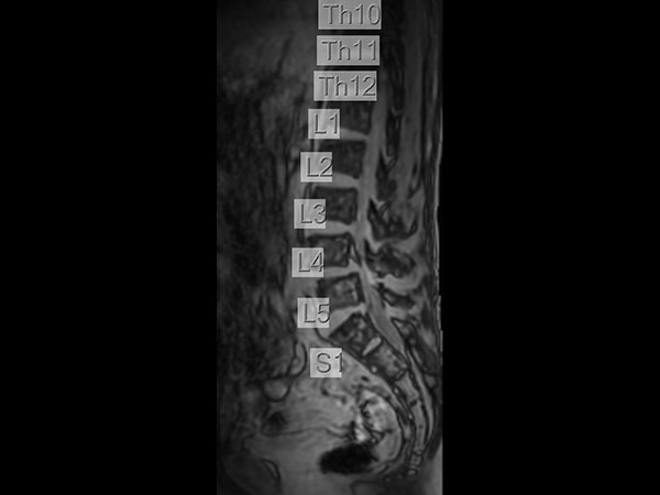 SmartExam Spine <sup>1</sup>