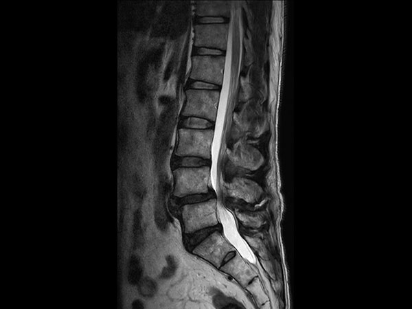 Sagittal T2w TSE