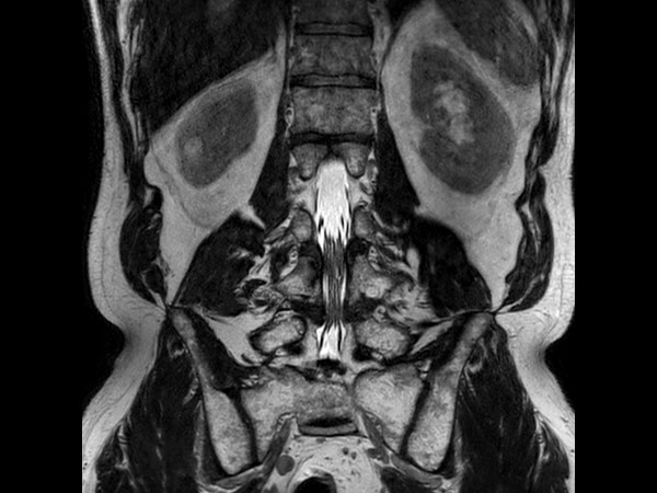 Coronal T2w 3D SpineVIEW