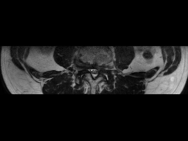 T2w 3D SpineVIEW (axial reformat)