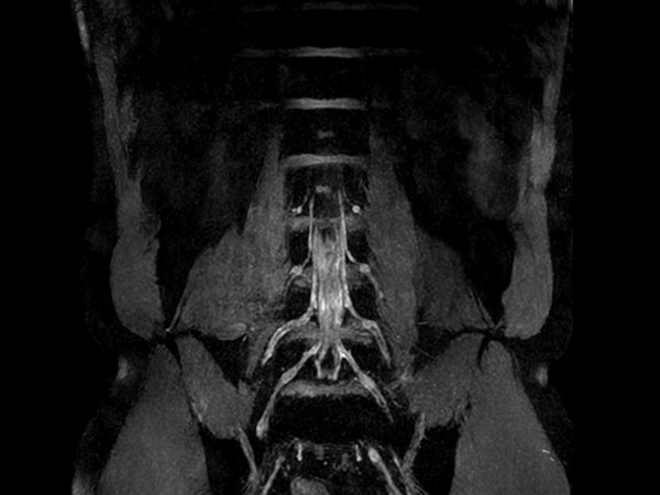 Coronal T2w FFE (MIP)