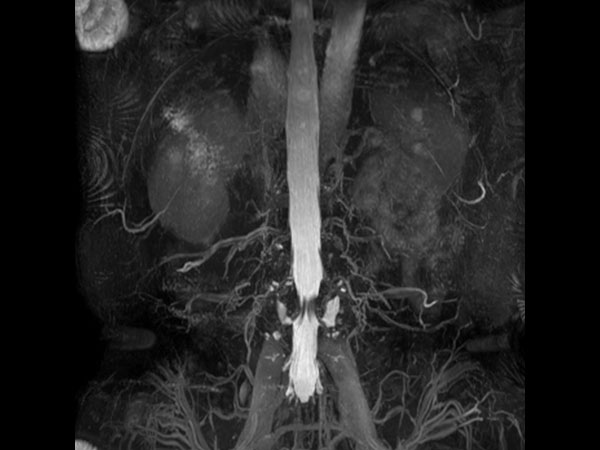 Coronal 3D bTFE (MIP)