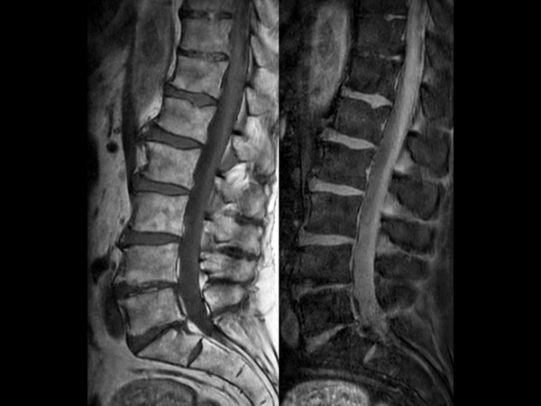 Sagittal mDIXON XD - T1w TSE