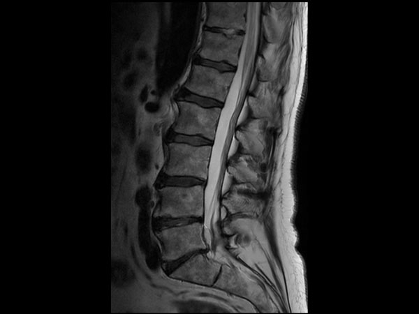 Sagittal T2w TSE 