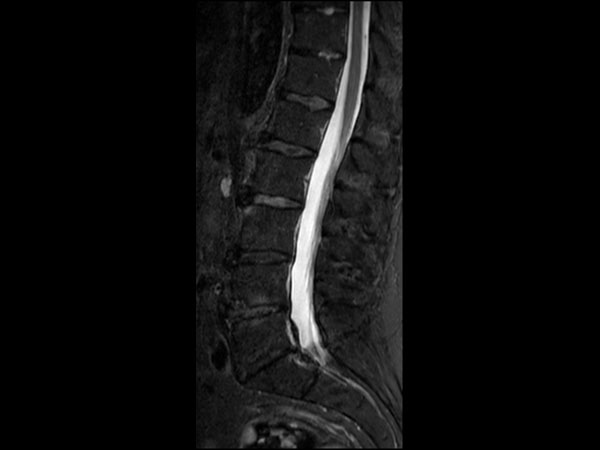 Sagittal STIR TSE 