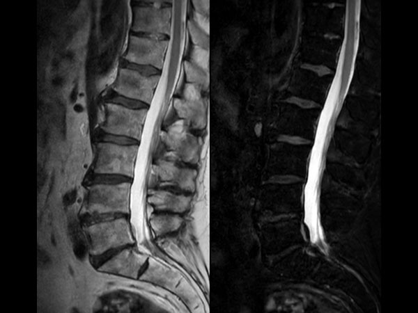 Sagittal mDIXON XD - T2w TSE