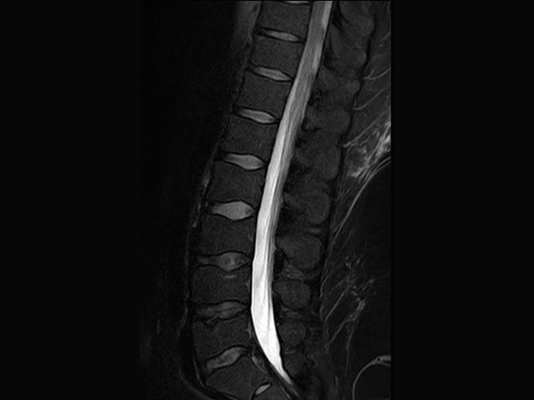 Sagittal T2w SPAIR