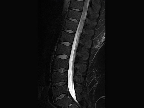 Sagittal T2w SPAIR