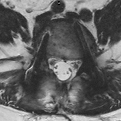 Axial T2w TSE (routine)