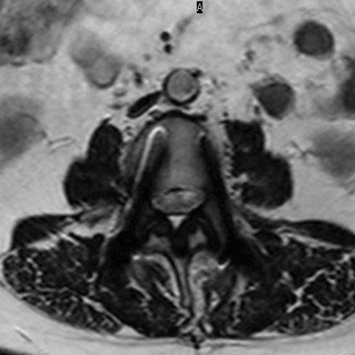 Axial T2w TSE (fast)