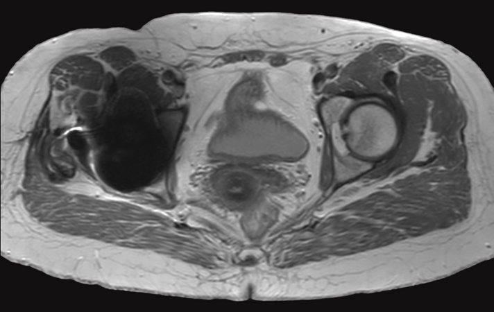 PDw TSE - High bandwidth