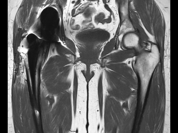 T1w TSE - High bandwidth