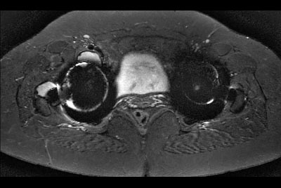 Hip imaging with metal implant using MARS at 3.0T