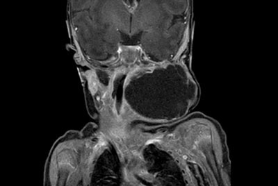 Pediatric Head/Neck tumor