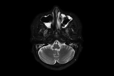 Sinus imaging with mDIXON XD