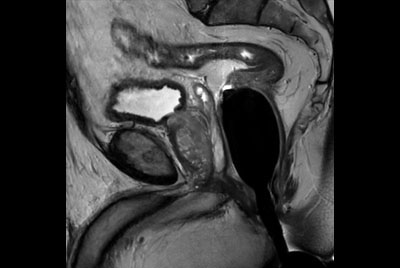 Prostate imaging with dS Endo + dS Torso coil