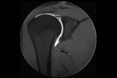 Motion-free MR Arthrogram shoulder imaging