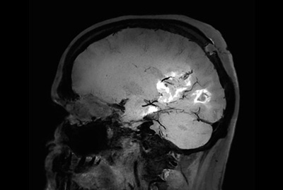 Black Blood imaging in brain
