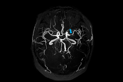 Imaging of vessels in brain