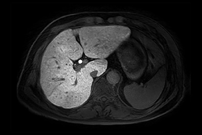 Free breathing abdominal imaging