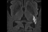 Brain imaging with Zoom Diffusion