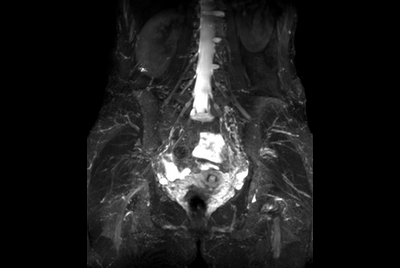 Lumbar Plexus imaging