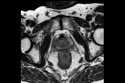 MRI simulation for prostate cancer treatment