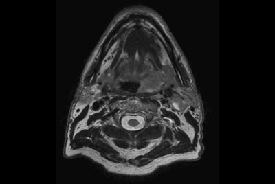 MRI simulation for oropharynx aquamous cell carcinoma treatment
