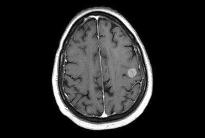MRI simulation for brain metastases treatment