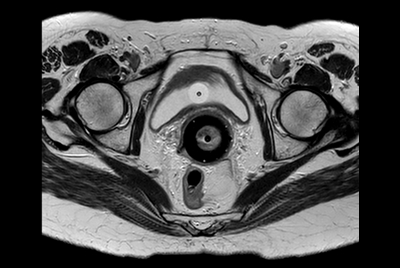MRI simulation for brachytherapy cervix