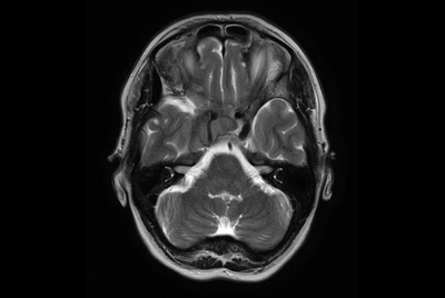 MRI simulation for brain stereotactics treatment