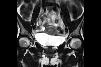 MRI simulation for cervix treatment – variable bladder filling state