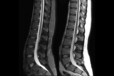 Lumbar Spine with mDIXON XD