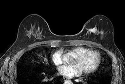 Breast lesion