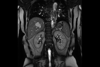 Liver hemangioma with Compressed SENSE
